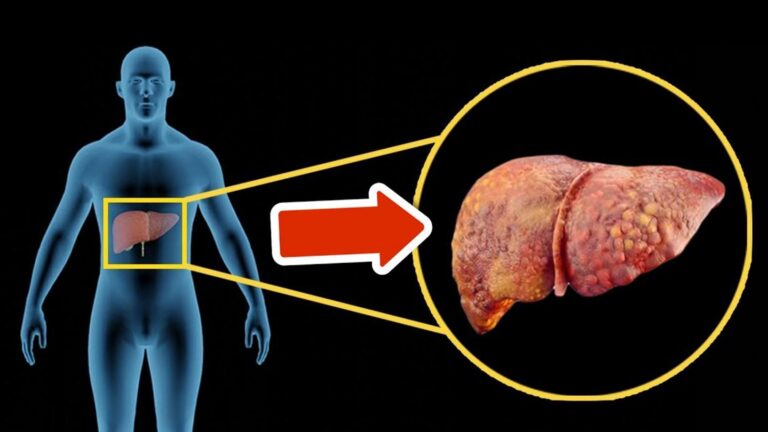 5 objawów, które mogą wskazywać na problem z wątrobą – nie ignoruj ich!